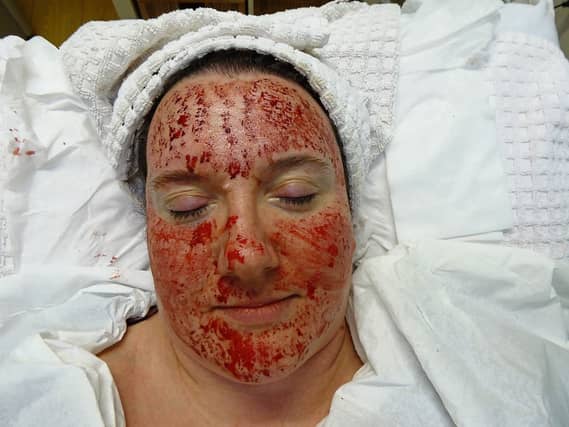 The Leader's Laura Coates mid-way through the PRP, or 'vampire facial' treatment