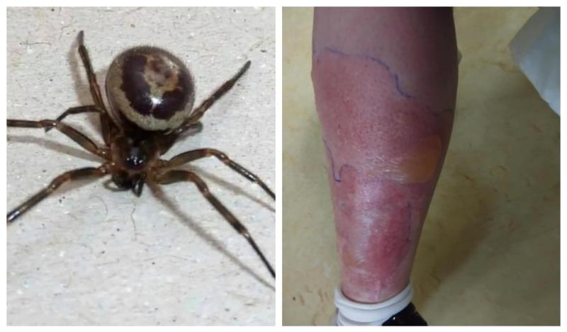 Woman hospitalised for a week after False Widow spider bite 