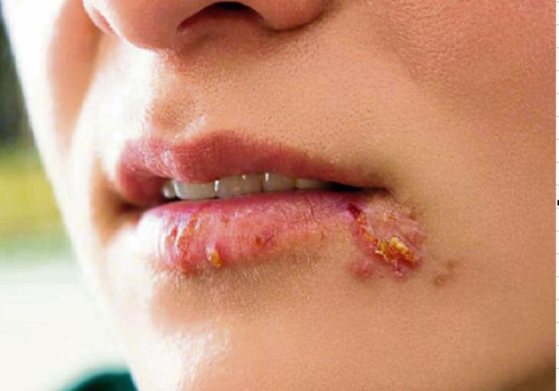 herpes