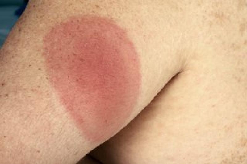 Call for awareness about potentially deadly disease at beauty sites across Kildare 